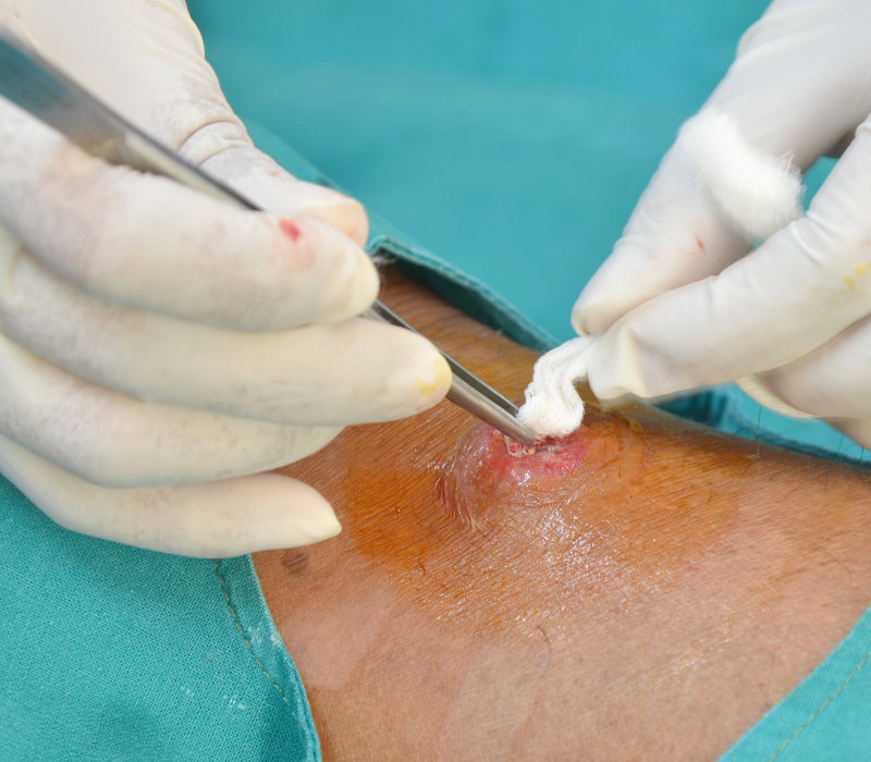 Abscess